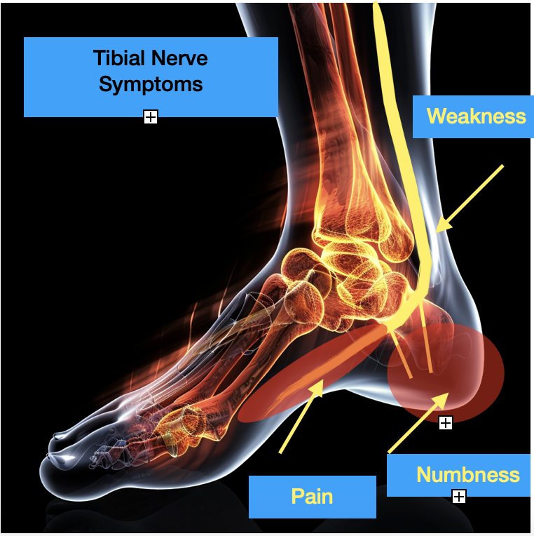 A picture depicting the symptoms of pain, numbness and weakness symptoms of the foot